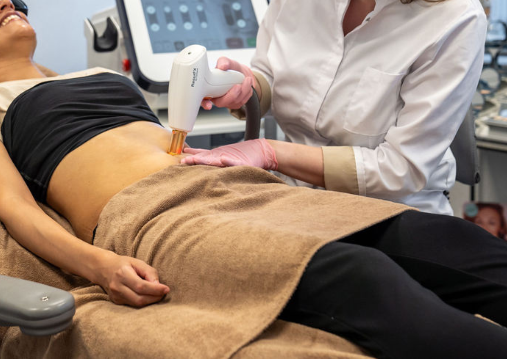 striae laser